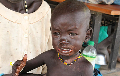 Ajak is one of our patients with measles